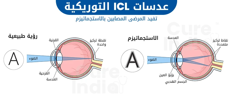 جراحة العدسات اللاصقة التوريكية في الهند